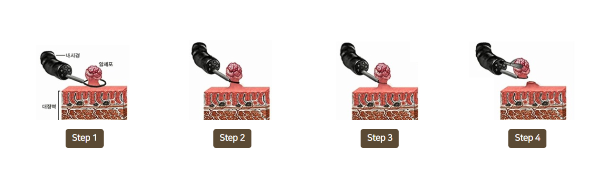 용종절제술 Step 1~4